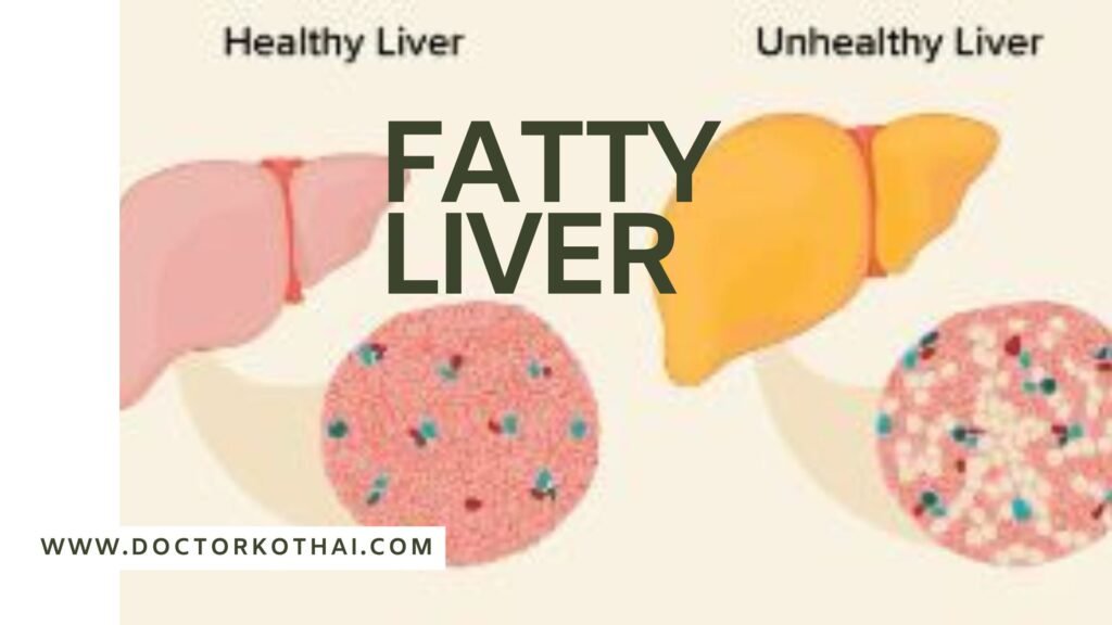 ফ্যাটি লিভার থেকে মুক্তির উপায়